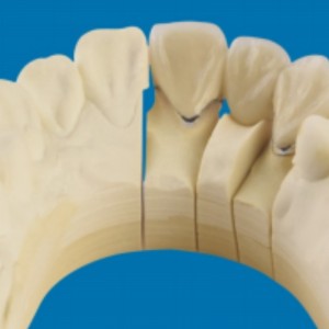 Miotal trom-fiacla poircealláin